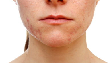 How To Cure Acne? A New Acne Vaccine Might Be The Answer